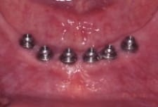 FiveImplants1