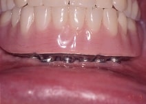FiveImplants2