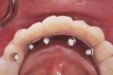 FiveImplants3