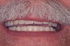 FiveImplants4
