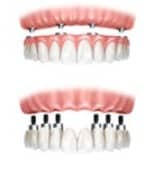 FiveImplants5