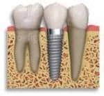 Implant1
