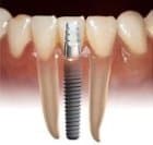 Implant2
