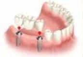 Implant3