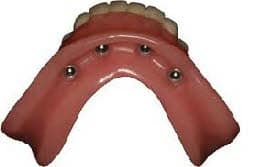 Implants2