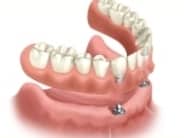 dentures1