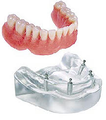 dentures2