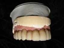 sixImplants1