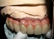 sixImplants2