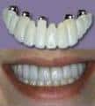 sixImplants3