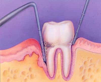 periodontal-probe
