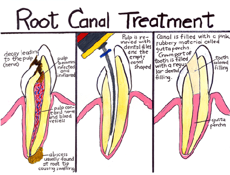 wp0de3b024 Diagram of root canal treatment showing removal of infected pulp, cleaning, filling and sealing the tooth