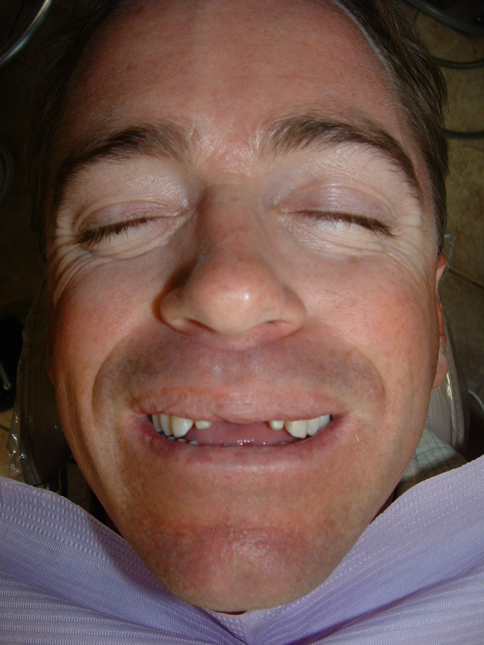 Before 2 implants + 2 porcelain crowns, case 18