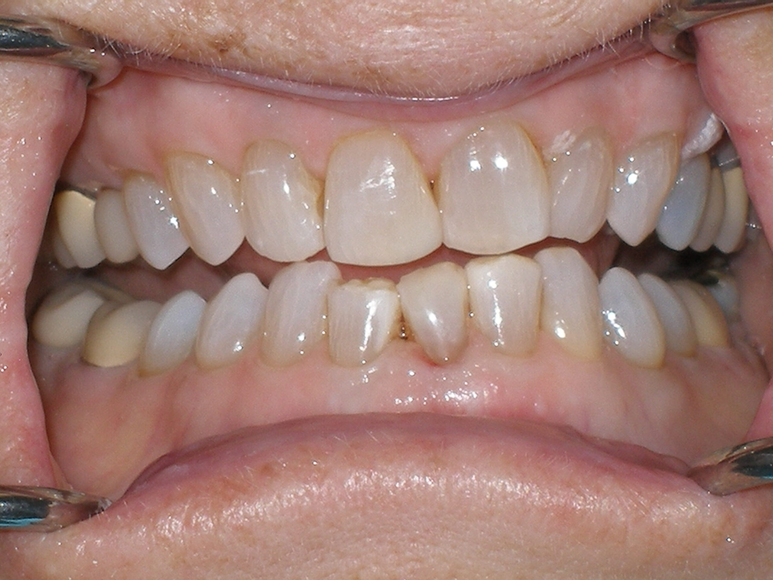 After composite veneers + bonding, case 19