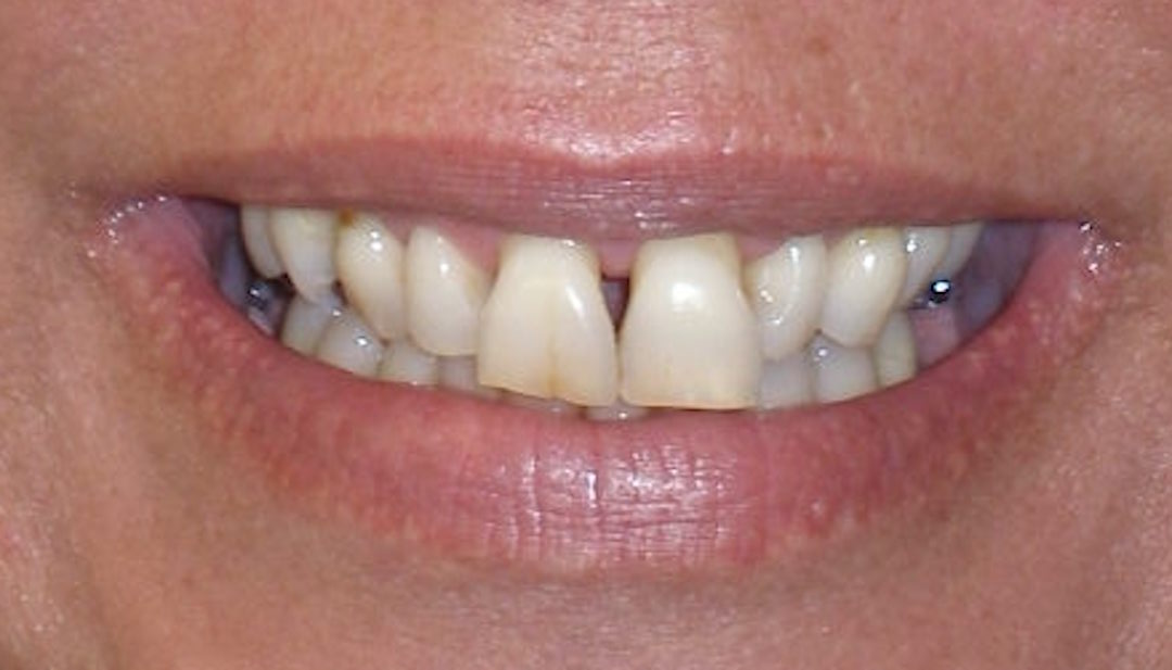 Before porcelain crowns, case 21