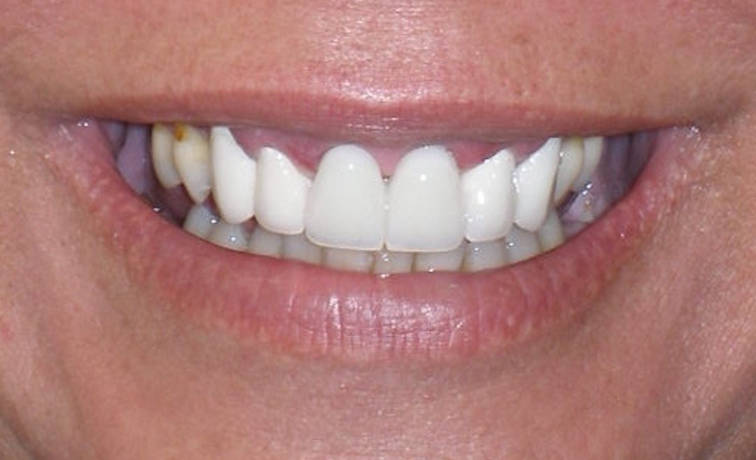 After porcelain crowns, case 21