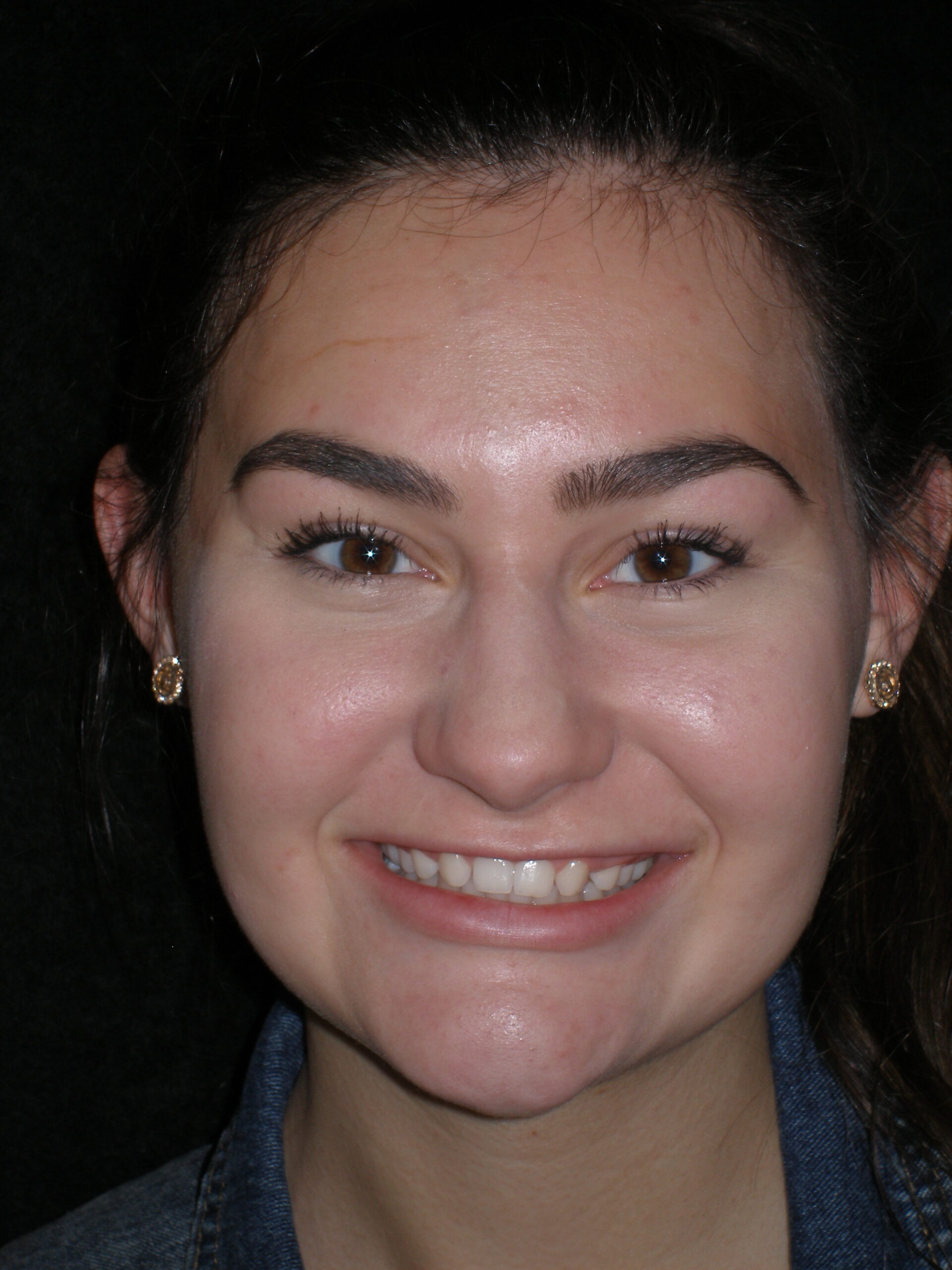 Before laser contouring + lumineers, case 23
