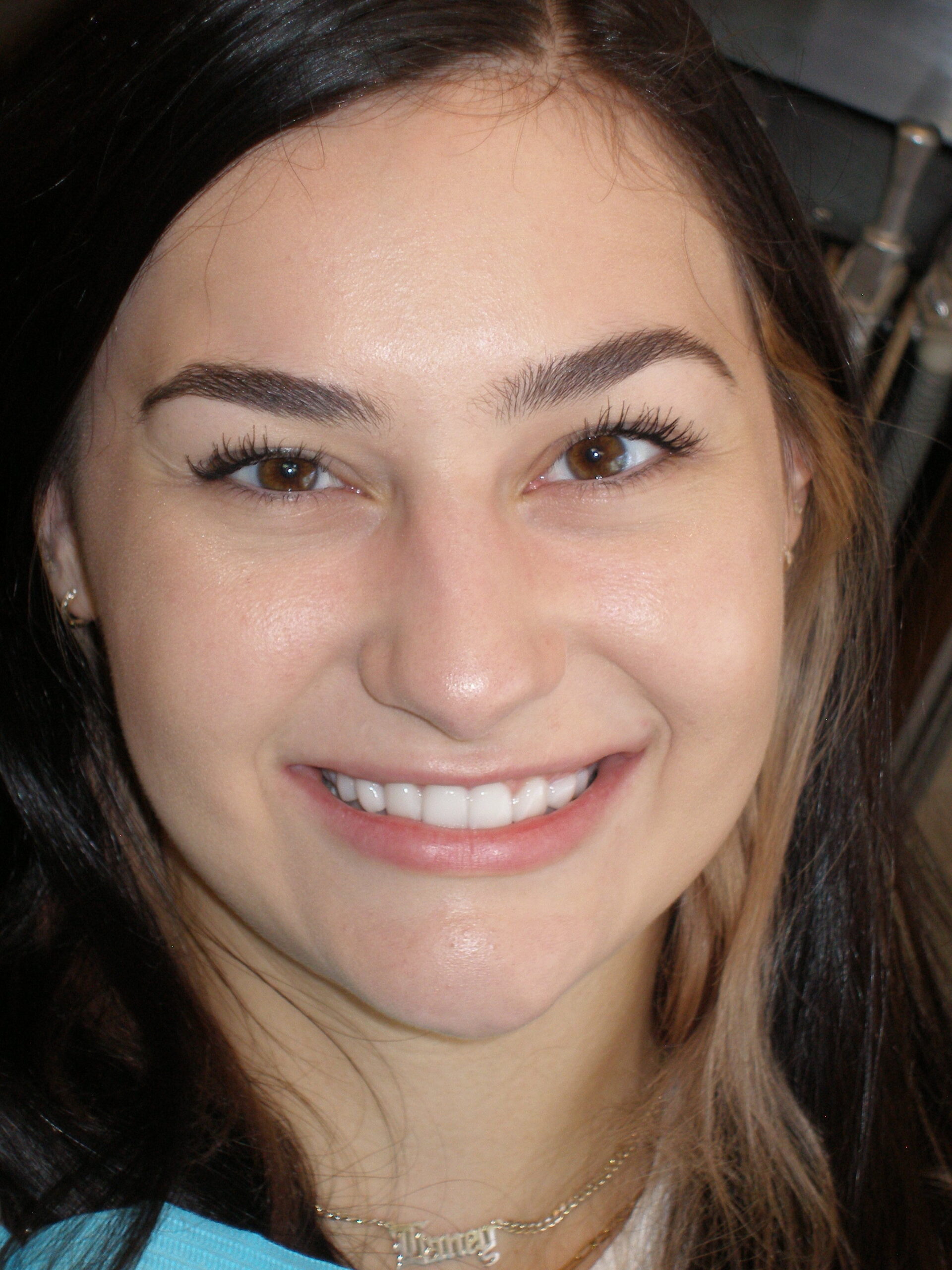 After laser contouring + lumineers, case 23
