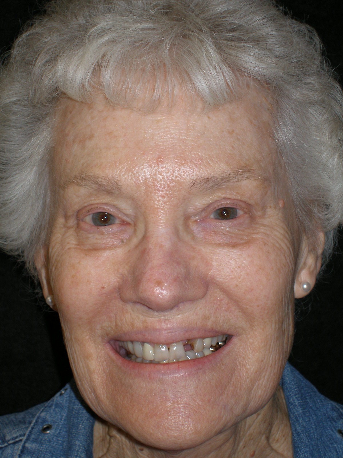 Before treatment, case 14