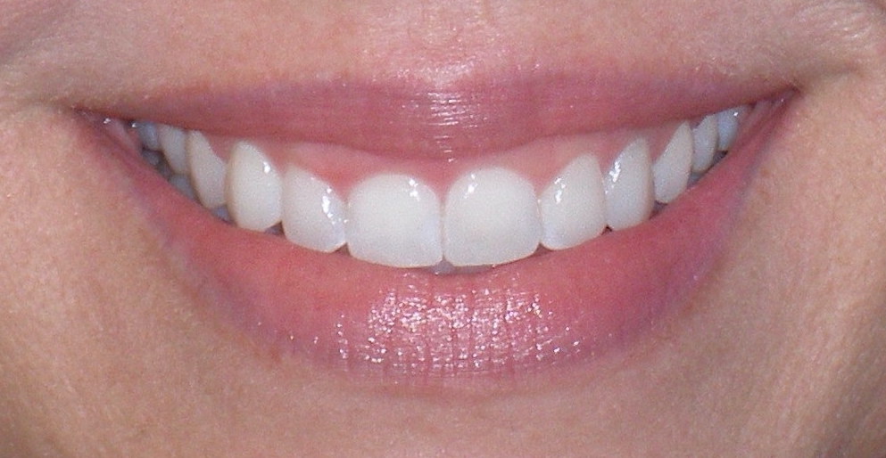 Smile before laser gum contouring