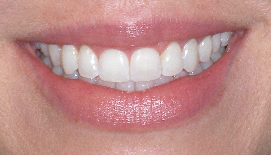 Smile after laser gum contouring