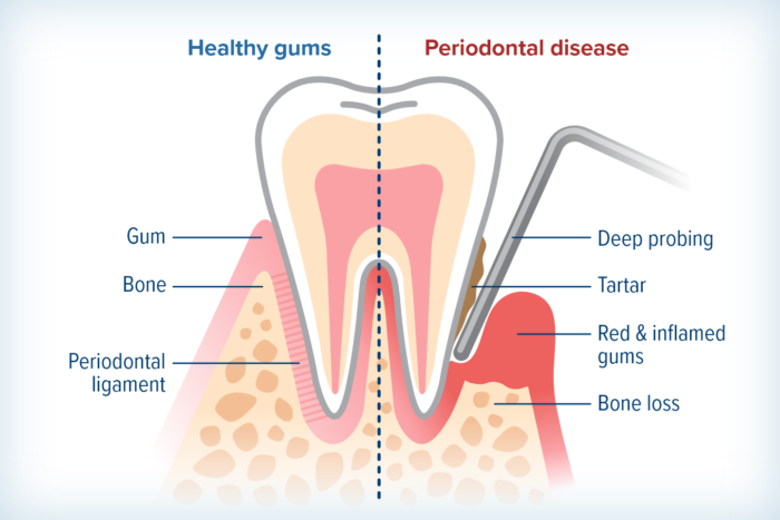 Periodontal Disease1 Photo Diagram comparing healthy gums with periodontal disease, tartar, inflamed gums, and bone loss