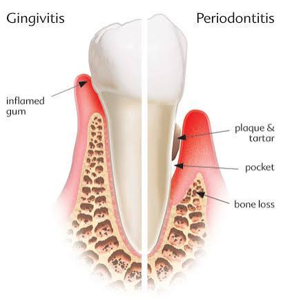 Diagram comparing gingivitis with periodontitis, including plaque, tartar, pockets, and bone loss