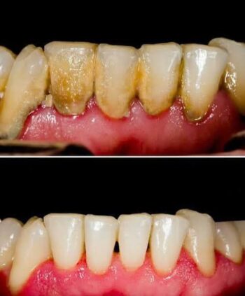 Teeth and gums before and after removal of visible tartar deposits