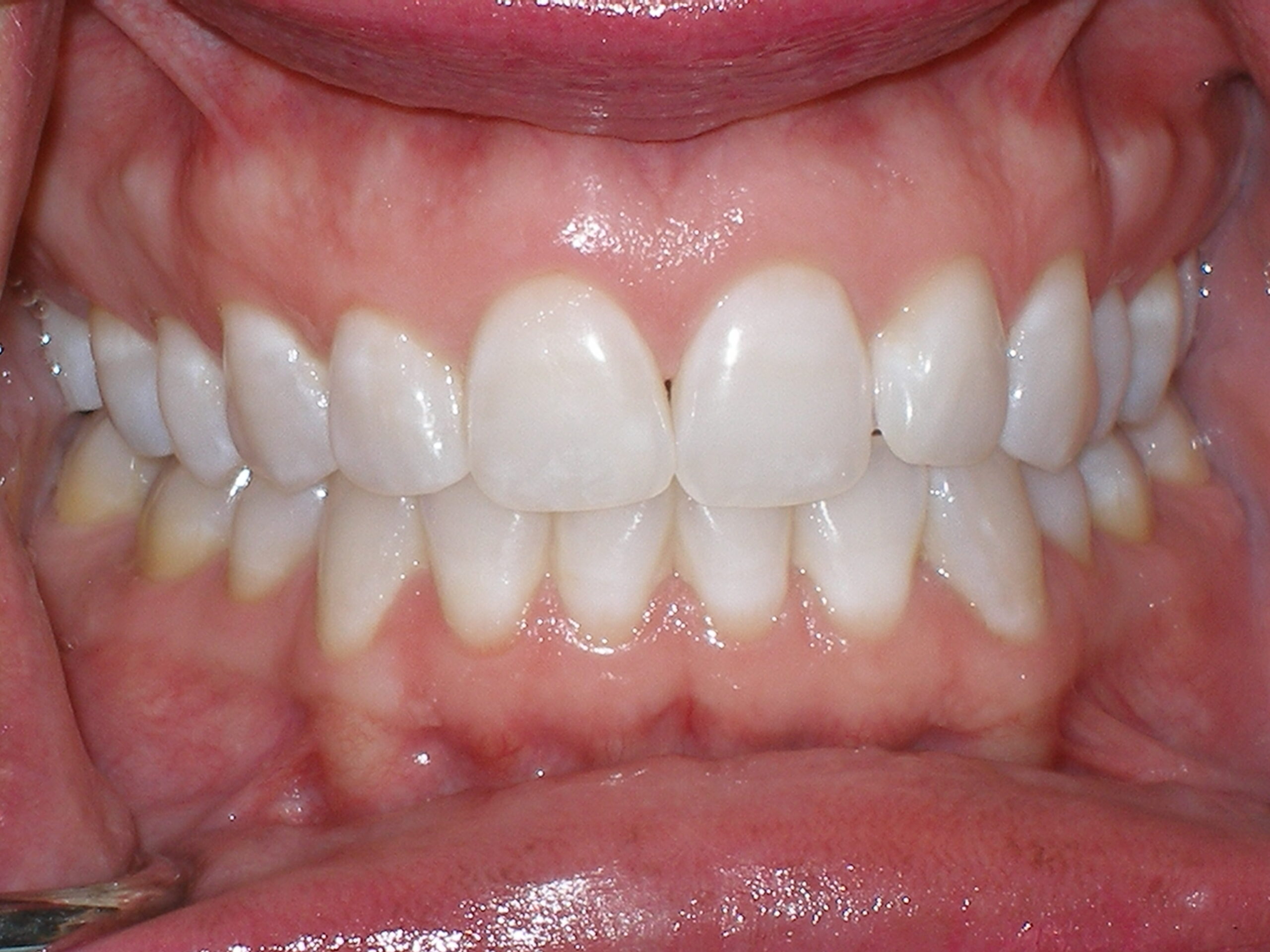 Teeth before Zoom whitening