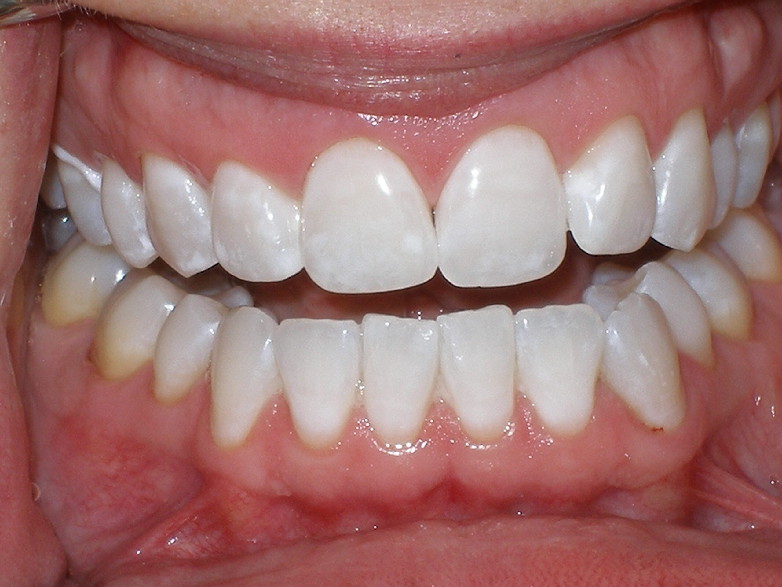 Teeth after Zoom whitening