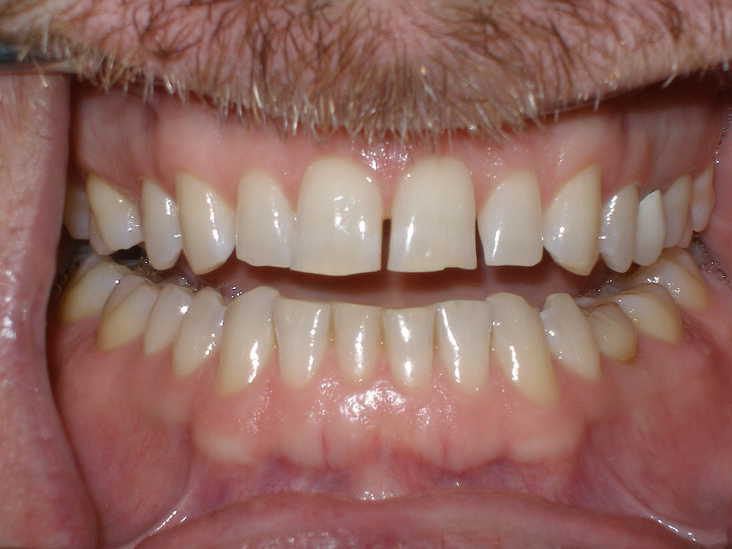 Teeth before Zoom whitening