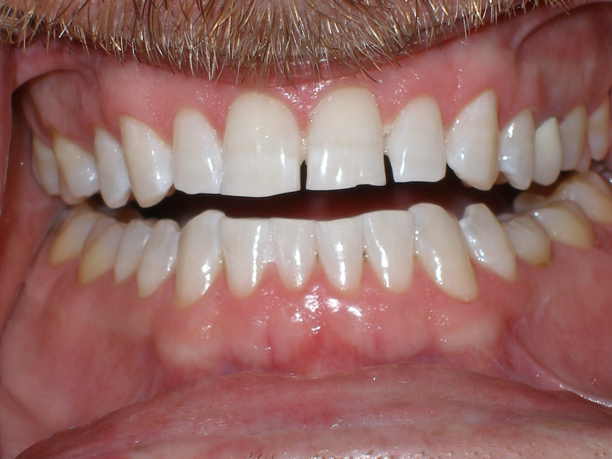 Teeth after Zoom whitening