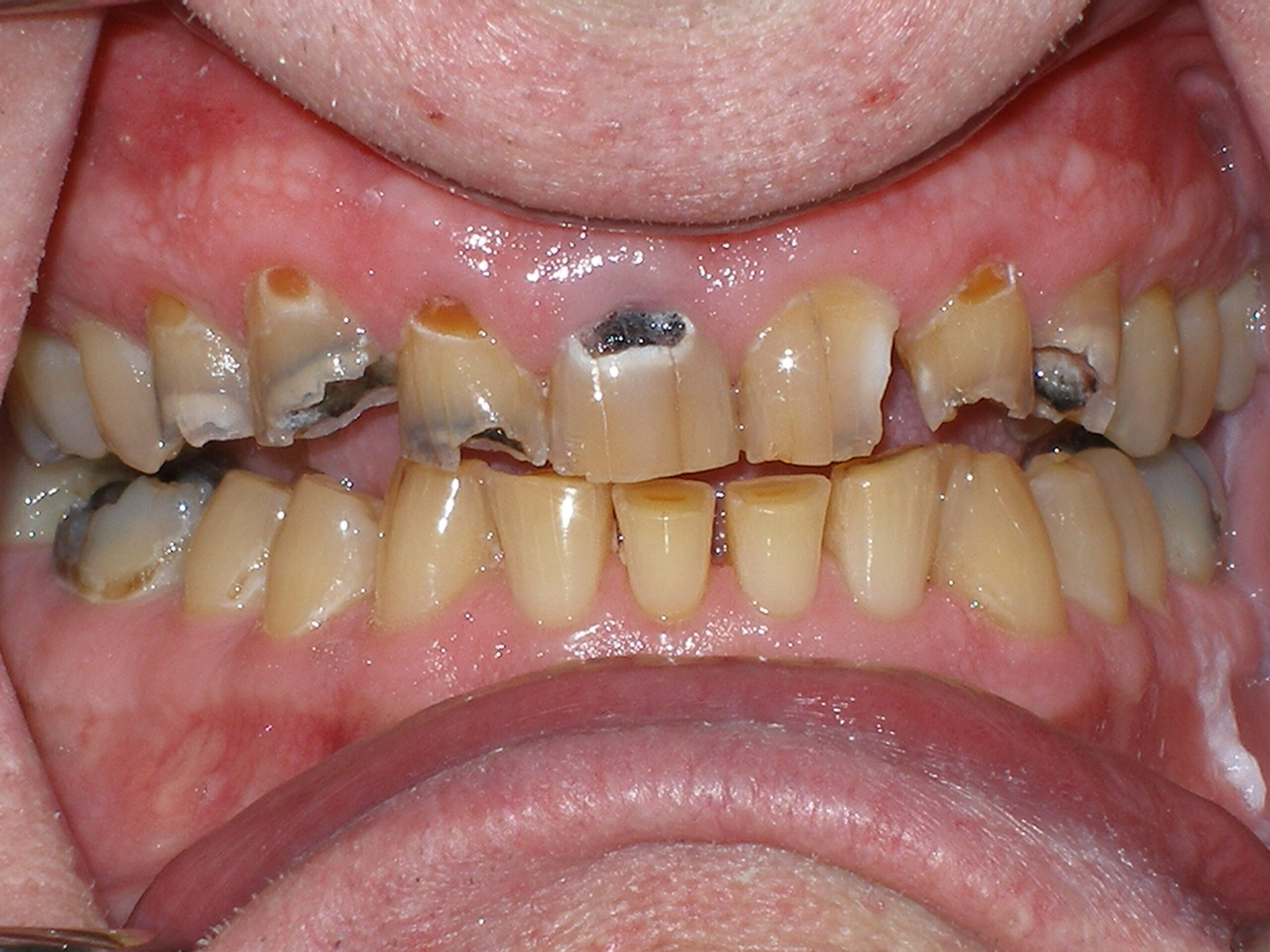 Before whitening, crowns and bonding, case 30